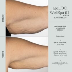 Well Spa IO Erfahrungen - Vorher - Nachher Oberarme